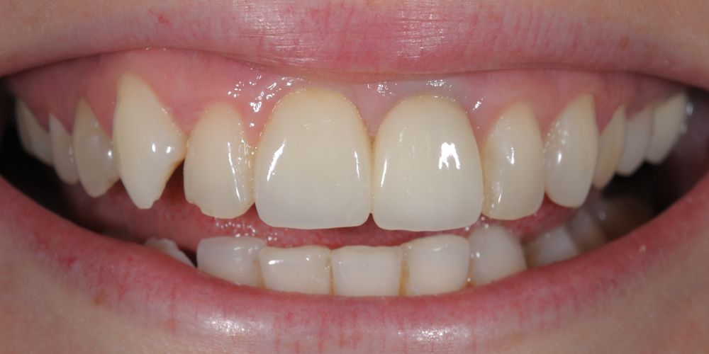 Протезирование двух центральных резцов цельнокерамическими коронками E.Max и отбеливание зубов - фото №2