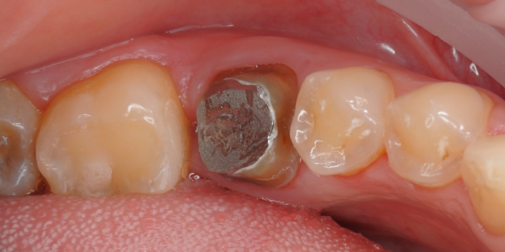 Произвели восстановление функции жевательного зуба разрушенного на 80% - фото №1