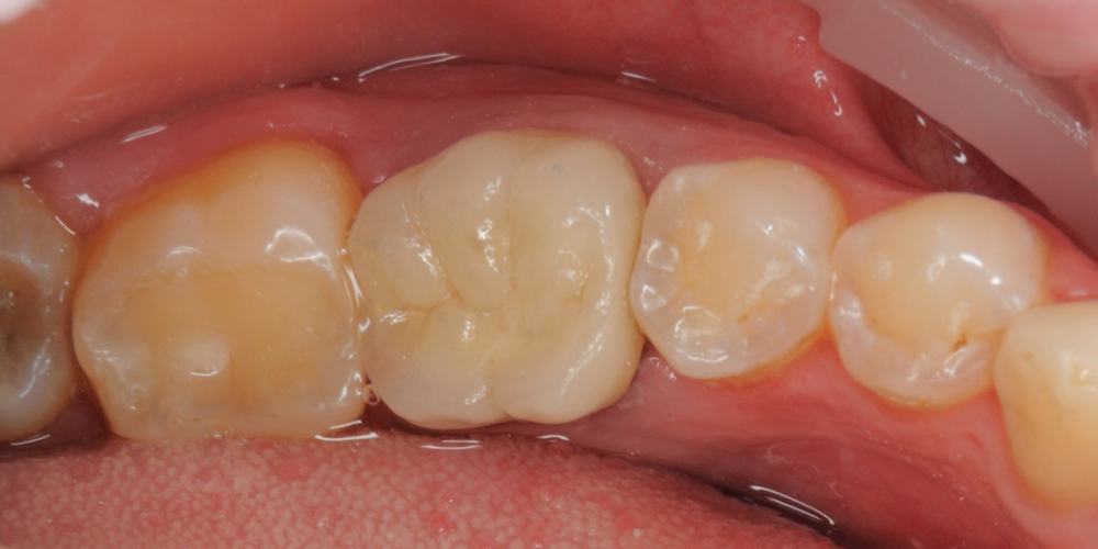 Произвели восстановление функции жевательного зуба разрушенного на 80% - фото №2
