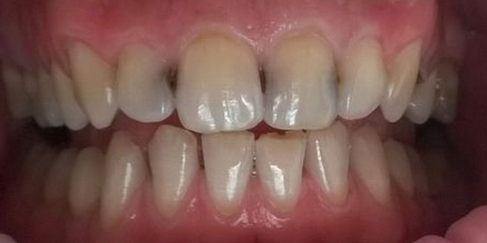 Лечения кариеса четырех передних зубов верхней челюсти современным композиционным материалом - фото №1