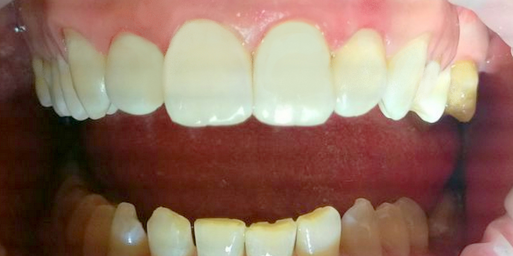Лечения кариеса четырех передних зубов верхней челюсти современным композиционным материалом - фото №2