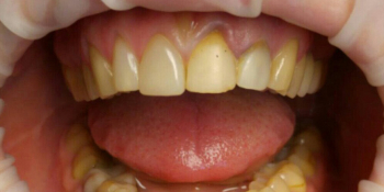 Реставрация зубов верхней челюсти - фото №1