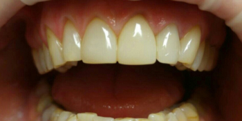 Реставрация зубов верхней челюсти - фото №2