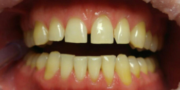 Профессиональное отбеливание зубов щадящей системой отбеливания Amazing White - фото №1