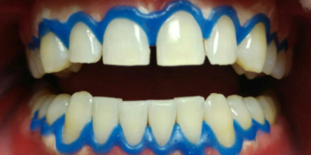 Профессиональное отбеливание зубов щадящей системой отбеливания Amazing White - фото №2