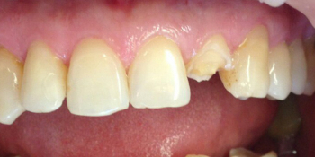 Реставрация переднего зуба, разрушенного более чем на 50% - фото №1
