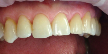 Реставрация переднего зуба, разрушенного более чем на 50% - фото №2