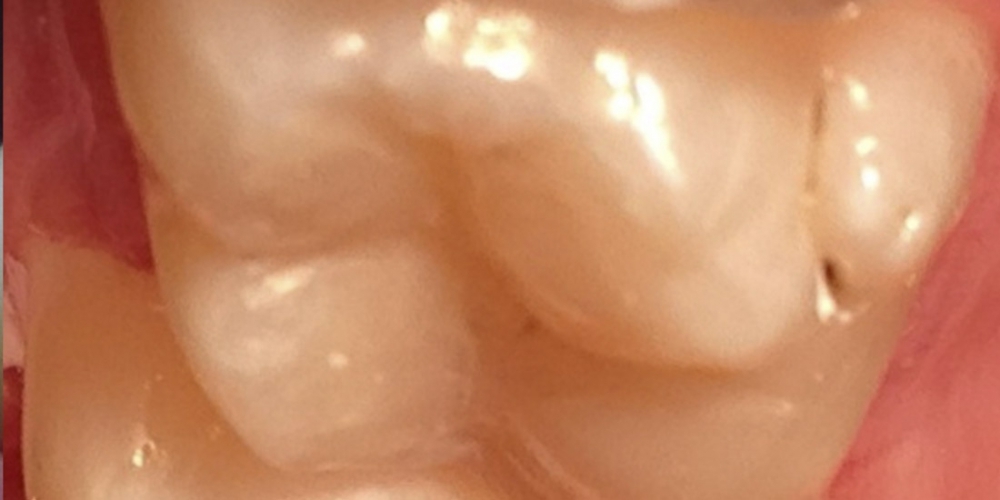 Лечение кариеса и реставрация зуба - фото №2