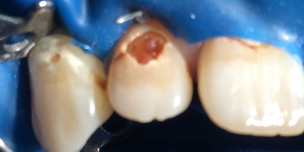 Результат лечения глубокого кариеса переднего зуба - фото №1
