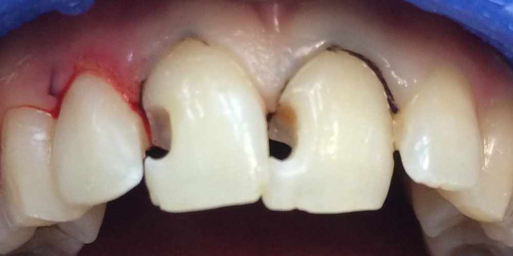 Лечение среднего кариеса на передних зубах + реставрация - фото №1