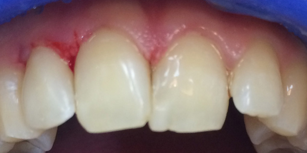 Лечение среднего кариеса на передних зубах + реставрация - фото №3