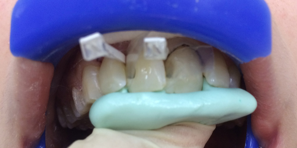 Лечение среднего кариеса на передних зубах + реставрация - фото №2