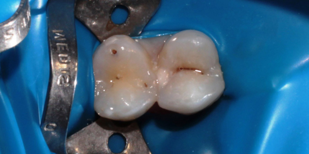 Лечение глубокого кариеса зуба 1.4 (верхний первый премоляр справа) - фото №1