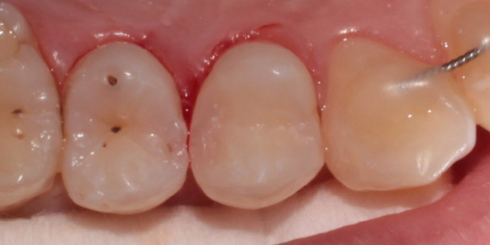 Лечение глубокого кариеса зуба 1.4 (верхний первый премоляр справа) - фото №4