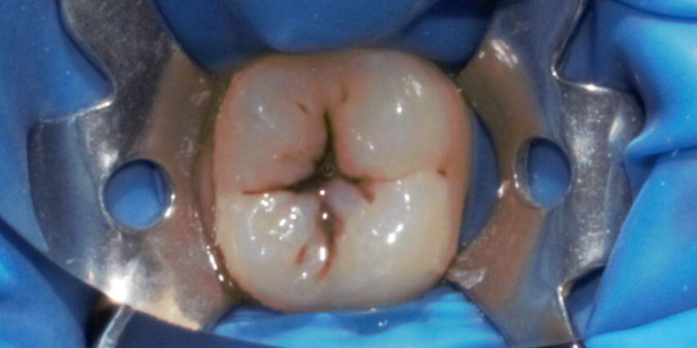 Лечение глубокого кариеса жевательного зуба 3.6 - фото №1