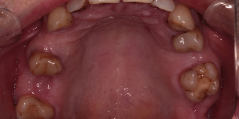 Протезирование верхнего зубного ряда металлокерамическими коронками - фото №1