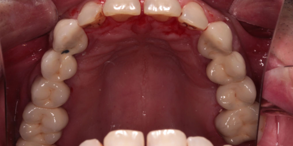 Протезирование верхнего зубного ряда металлокерамическими коронками - фото №2