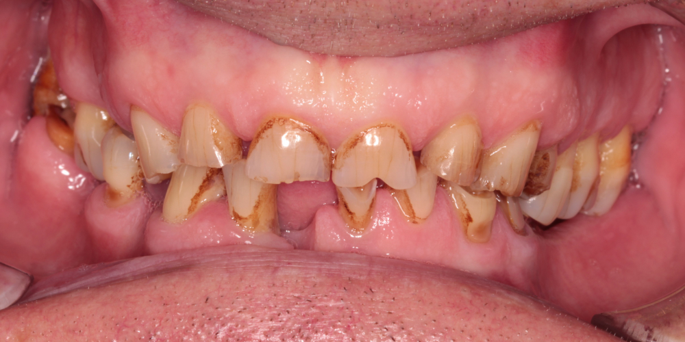 Тотальная реабилитация зубных рядов металлокерамическими коронками + бюгельные протезы - фото №1