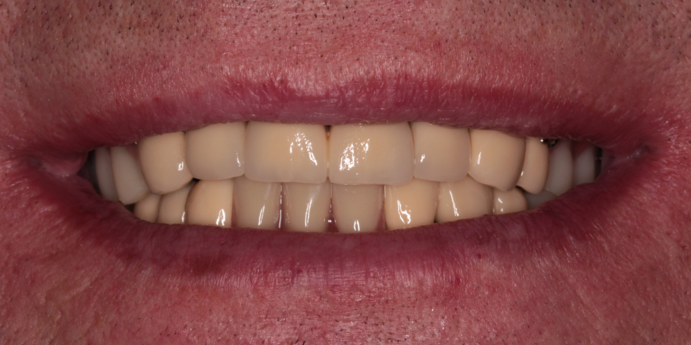 Тотальная реабилитация зубных рядов металлокерамическими коронками + бюгельные протезы - фото №2