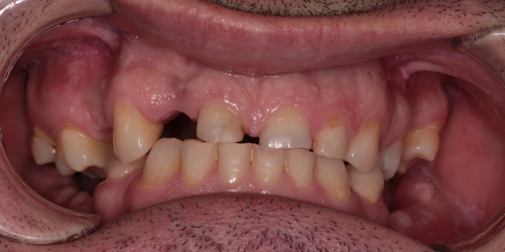 Тотальная реабилитация зубных рядов, фото до и после - фото №1