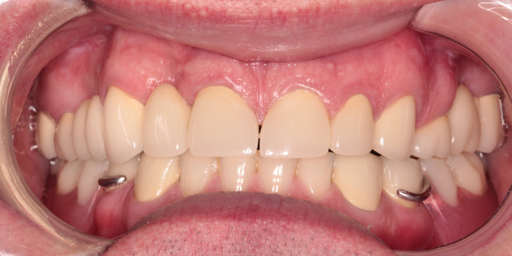 Тотальная реабилитация зубных рядов, фото до и после - фото №2