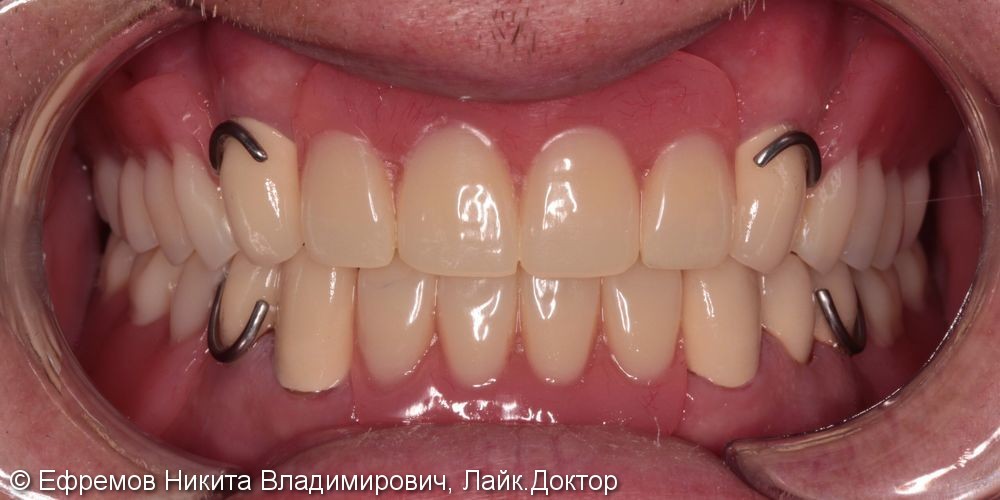 Тотальная реабилитация зубных рядов с помощью металлокерамических коронок и съёмных пластиночных протезов - фото №2
