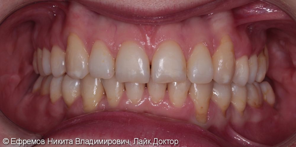 Установка виниров после ортодонтического лечения - фото №1