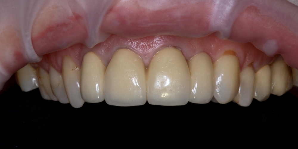 Коронки из диоксида циркония на передние зубы - фото №1