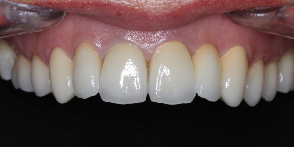 Коронки из диоксида циркония на передние зубы - фото №2