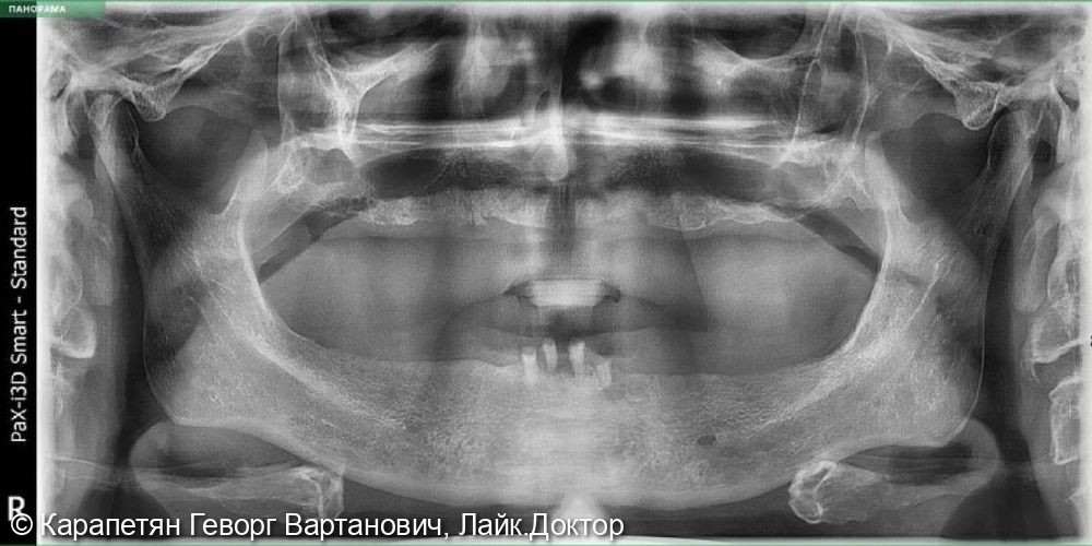 Имплантация по методике All-on-4 (всё на четырёх) - фото №2