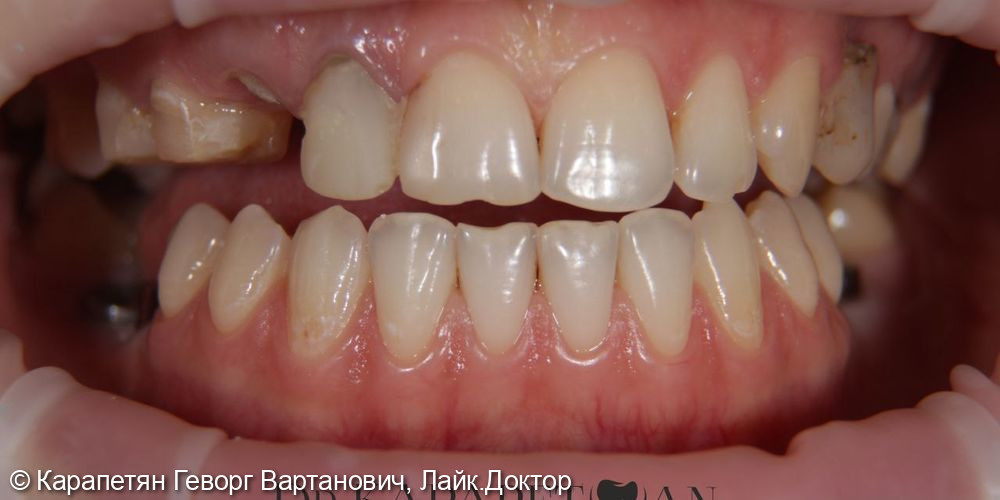 Установка виниров на зубы, стоимость 20.000 рублей за 1 единицу - фото №1