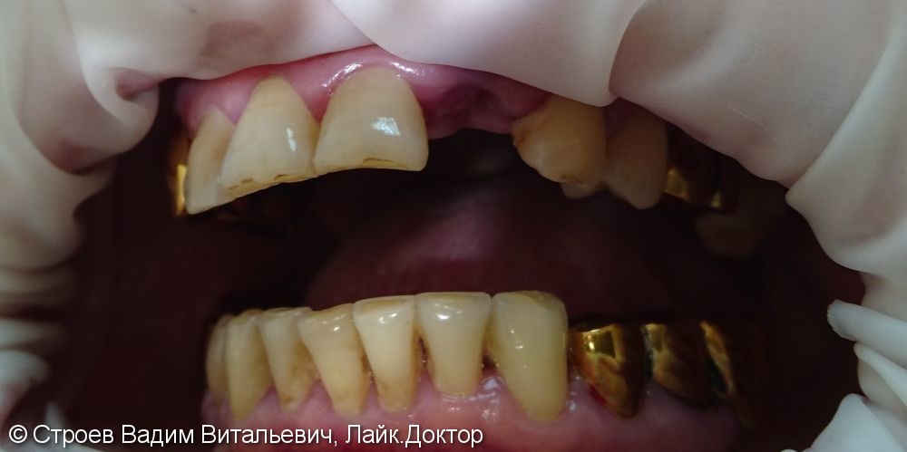 Имплантация отсутствующего зуба - фото №1