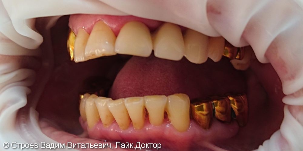 Имплантация отсутствующего зуба - фото №2