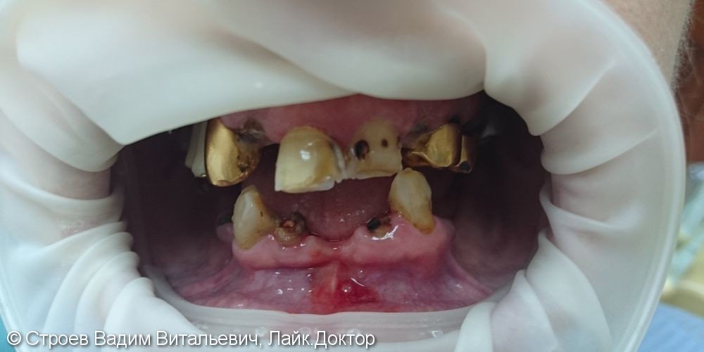 Полное восстановление зубного ряда - фото №1