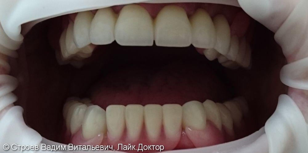 Полное восстановление зубного ряда - фото №2
