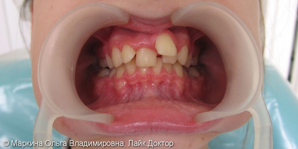 Клинический случай выравнивания зубного ряда на брекетах Биоквик фирмы Forestadent - фото №1