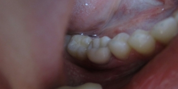 Реставрация жевательного зуба - фото №2