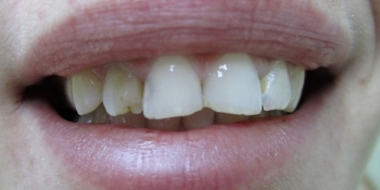 Реставрация фронтального зуба - фото №1