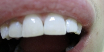 Реставрация фронтального зуба - фото №2