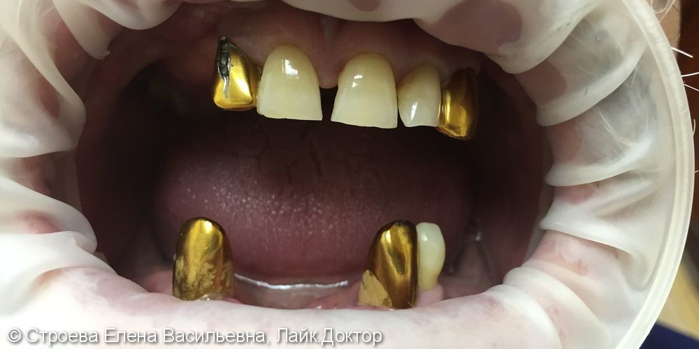 Восстановление зубного ряда, протезы, коронки - фото №1
