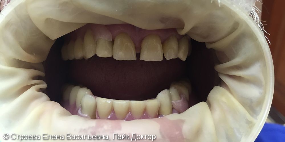 Восстановление зубного ряда, протезы, коронки - фото №2