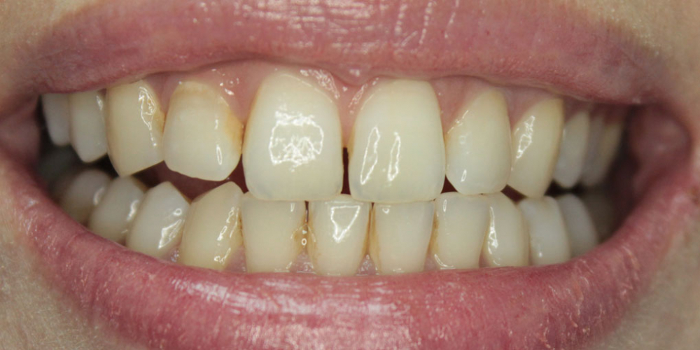 Результат отбеливания зубов ZOOM-4 - фото №1