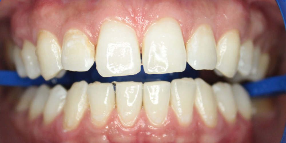 Результат отбеливания зубов ZOOM-4 - фото №2