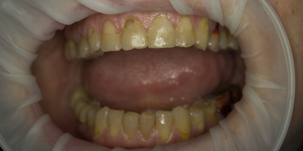 Восстановление двух зубов цельнокерамическими коронками Е-мах - фото №1