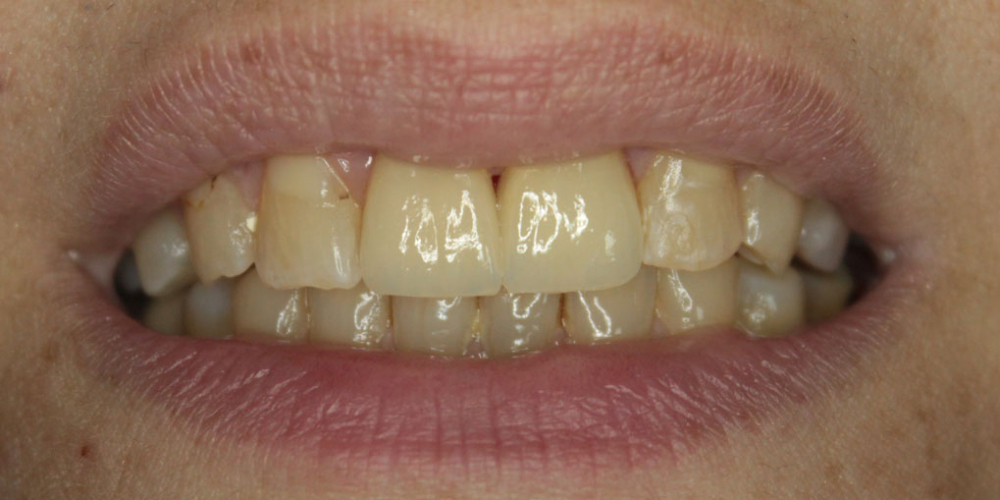 Восстановление двух зубов цельнокерамическими коронками Е-мах - фото №3