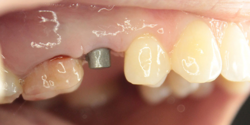 Восстановление зуба имплантация Osstem + протезирование м/к коронкой - фото №1