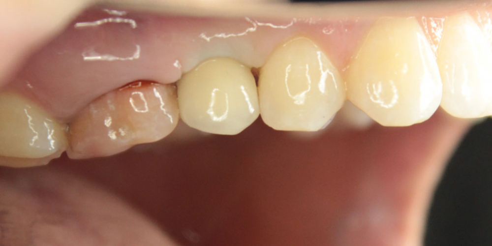 Восстановление зуба имплантация Osstem + протезирование м/к коронкой - фото №2