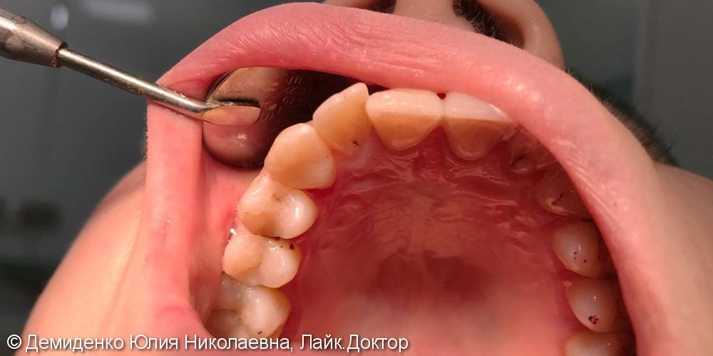 Замена старой пломбы и лечение глубокого кариеса 13 зуба - фото №2