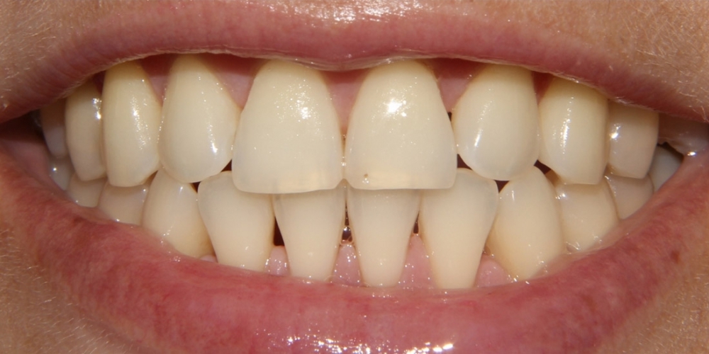Результат отбеливания зубов системой Zoom-3 - фото №1