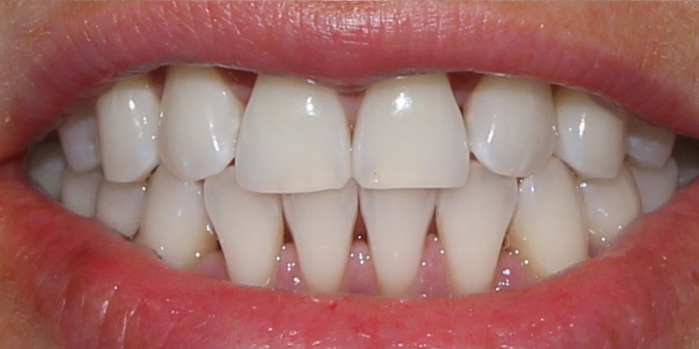 Результат отбеливания зубов системой Zoom-3 - фото №2